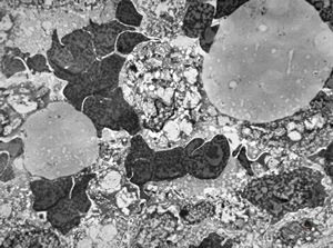 Whipple disease Whipple disease